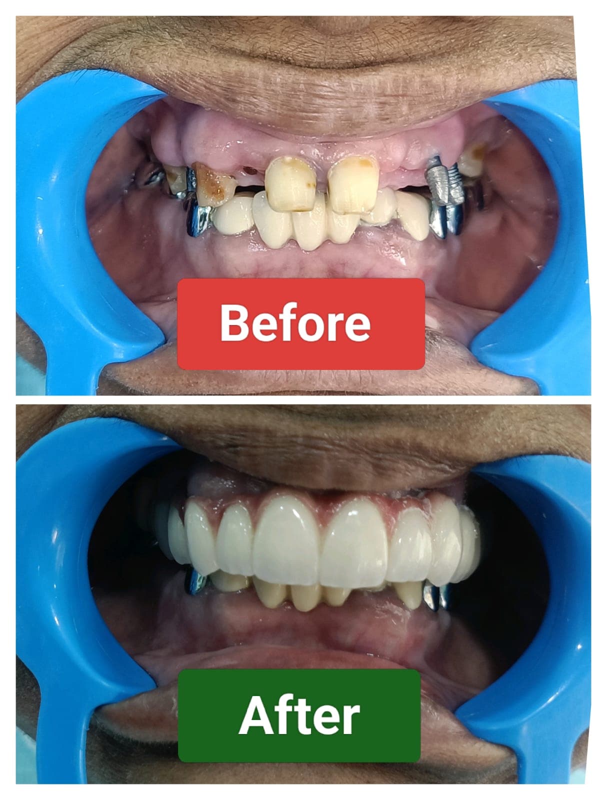 A close-up of a perfectly aligned and white smile.